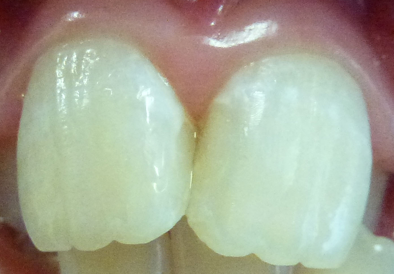 White Fillings - After