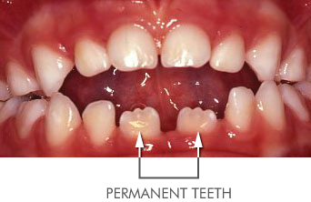 soother teeth