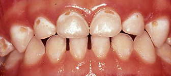 toddlers front teeth decaying