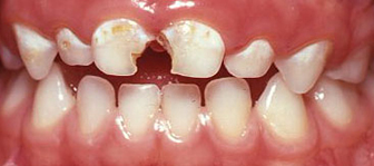 front tooth decay