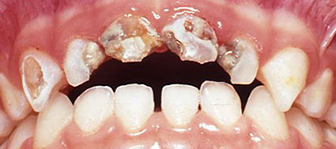 kids decayed teeth