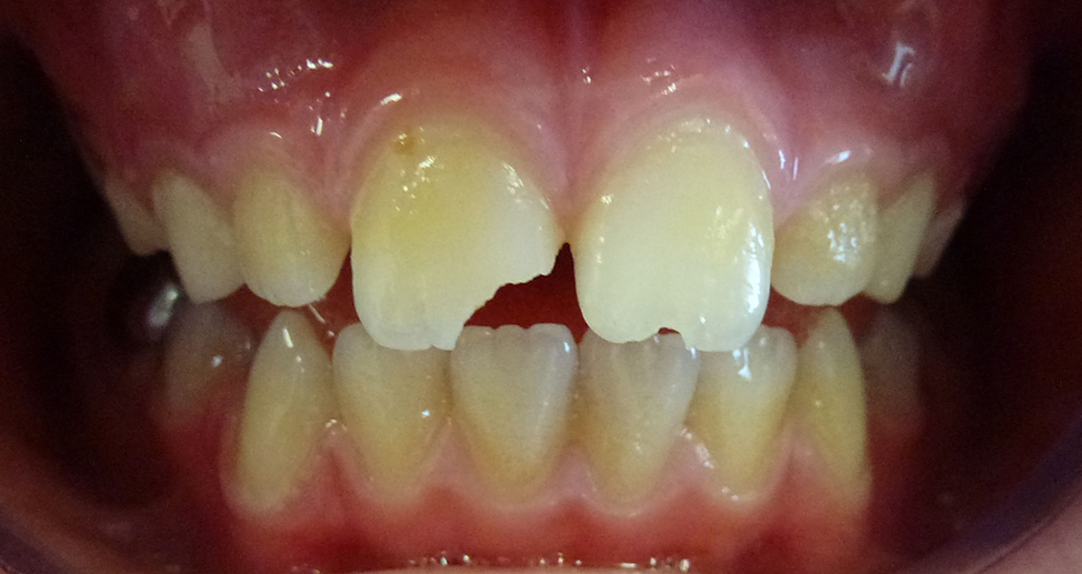 Trauma to Permanent Teeth - Before