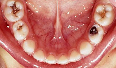 Decay in primary (baby) molars
