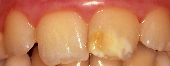 Moderate Incisor M.I.H. - Before Treatment