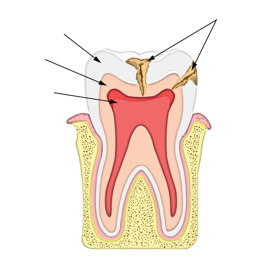 deciduous teeth susceptible caries