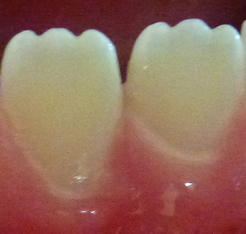 Lower permanent (adult) central incisors