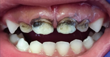 Front (primary) teeth with tooth decay - AFTER application of SDF
