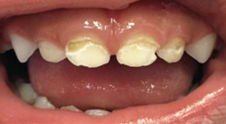 Front (primary) teeth with tooth decay - BEFORE application of SDF