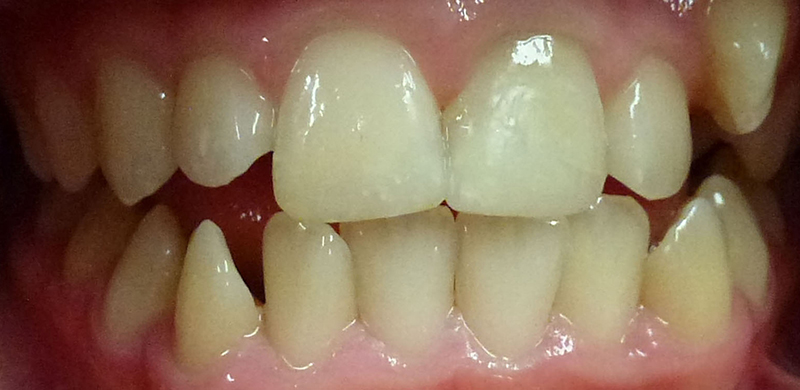 Trauma to Permanent Teeth - After