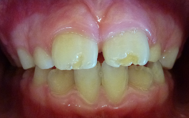 Defects on Permanent (Adult) Teeth