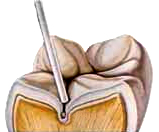 Toothbrush bristles is too large to clean out grooves in tooth