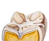 Fissure sealant covering grooves in tooth to prevent cavity forming