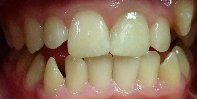 White Fillings - After