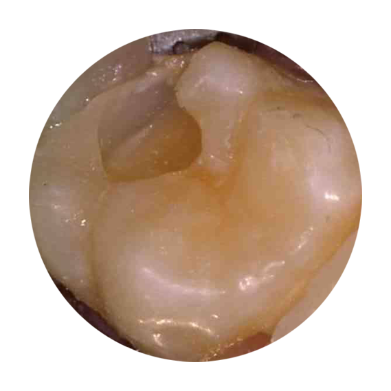 White Fillings - During Treatment