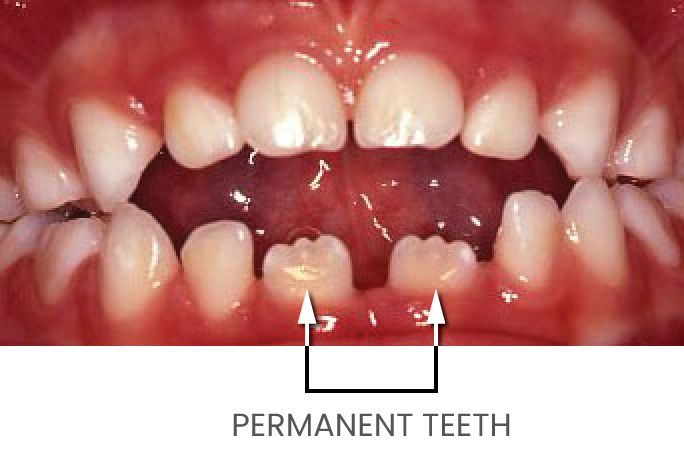 Incorrect Position of Teeth