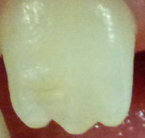 Upper permanent central (adult) incisor