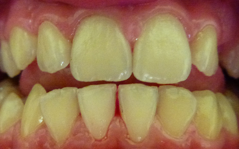 Oral Hygiene - After