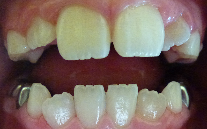 decalcification in baby teeth