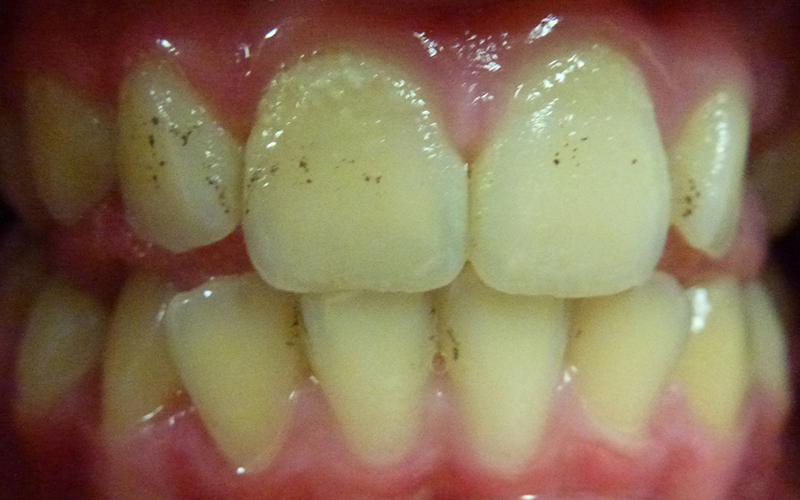 decalcification in baby teeth