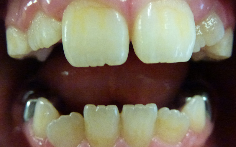 Oral Hygiene - Before