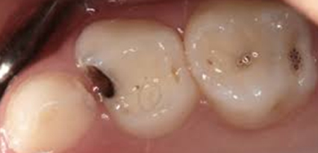 Back baby (primary) molars with tooth decay - AFTER application of SDF
