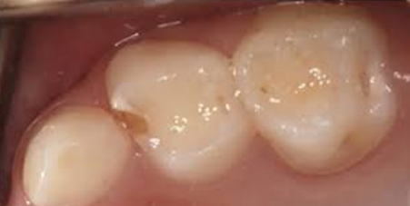 Back baby (primary) molars with tooth decay – BEFORE application of SDF