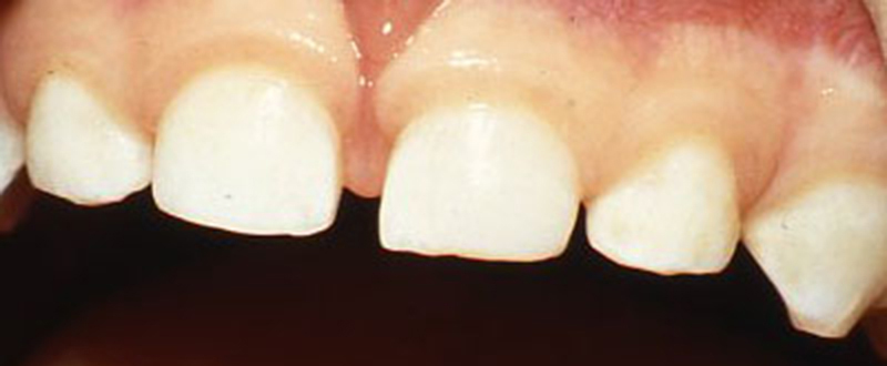 Trauma to Primary (Baby) Teeth - After