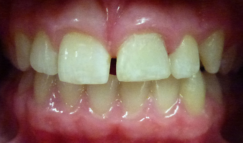 Trauma to Permanent Teeth - After