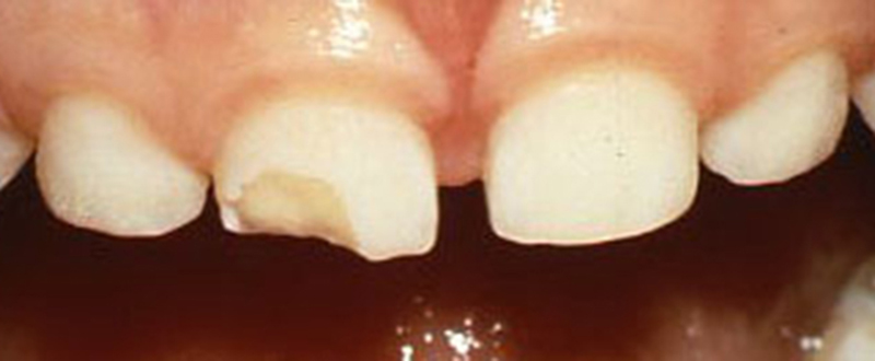 Trauma to Primary (Baby) Teeth - Before