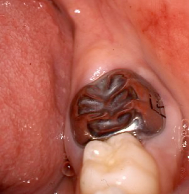 M.I.H. defective permanent tooth - after