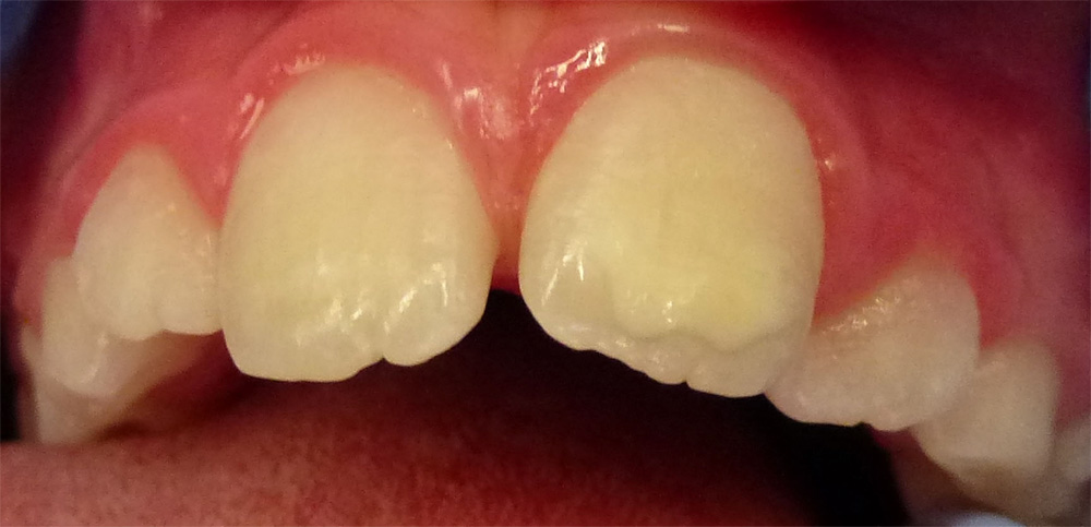 Mild MIH discolouration of permanent front tooth