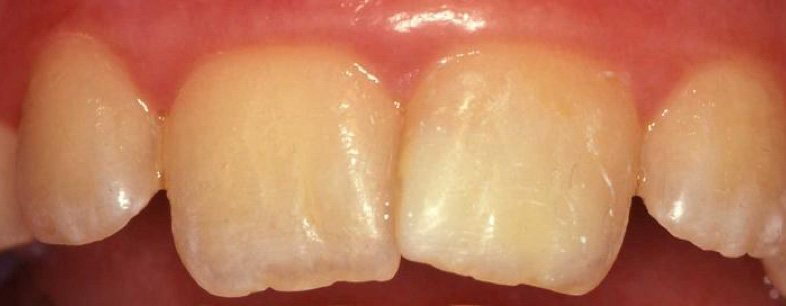 Moderate Incisor M.I.H. - After Treatment