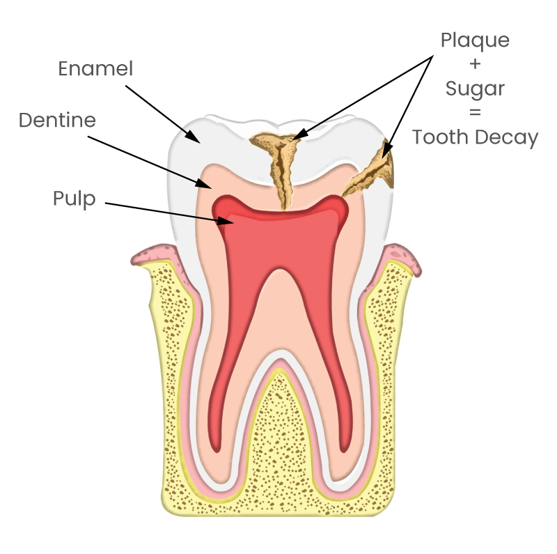 Tooth cavity